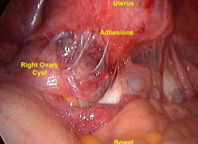 ovarian cyst cysts pain bladder severe bowel disturbances rarely leak cause