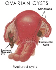 Ovarian Cysts - Anthony Siow