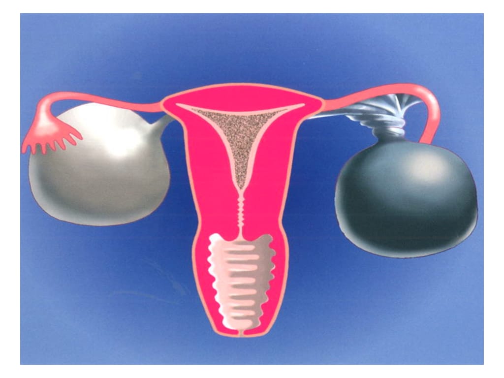 Ovarian Cysts - Anthony Siow