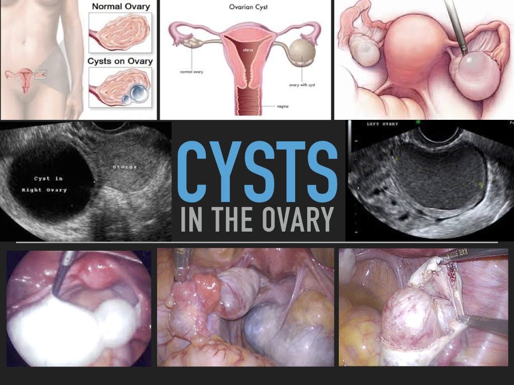 Ovarian Cysts - Anthony Siow
