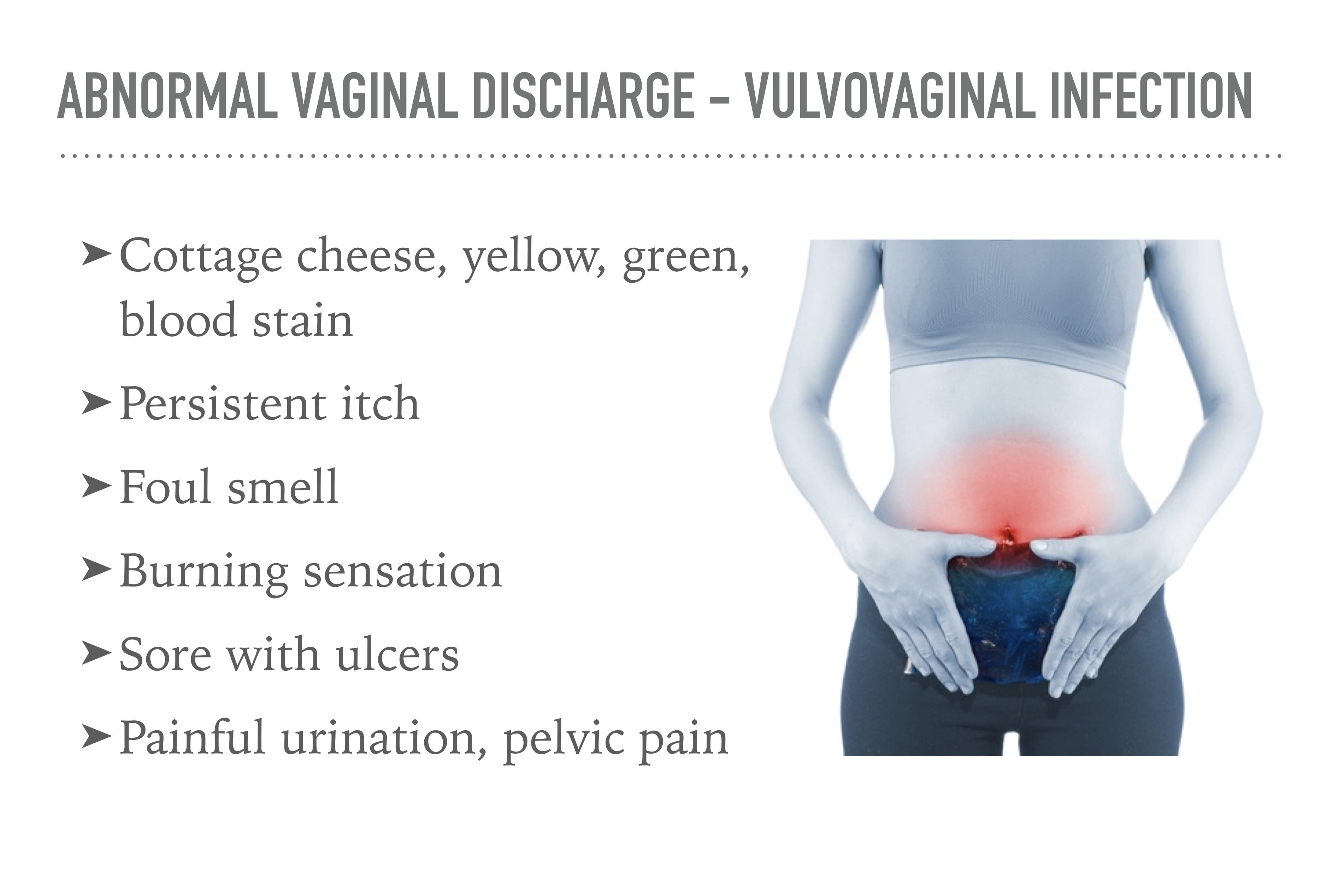 Vaginal Discharge & I