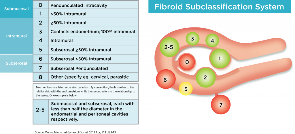 fibroids-anthony-siow