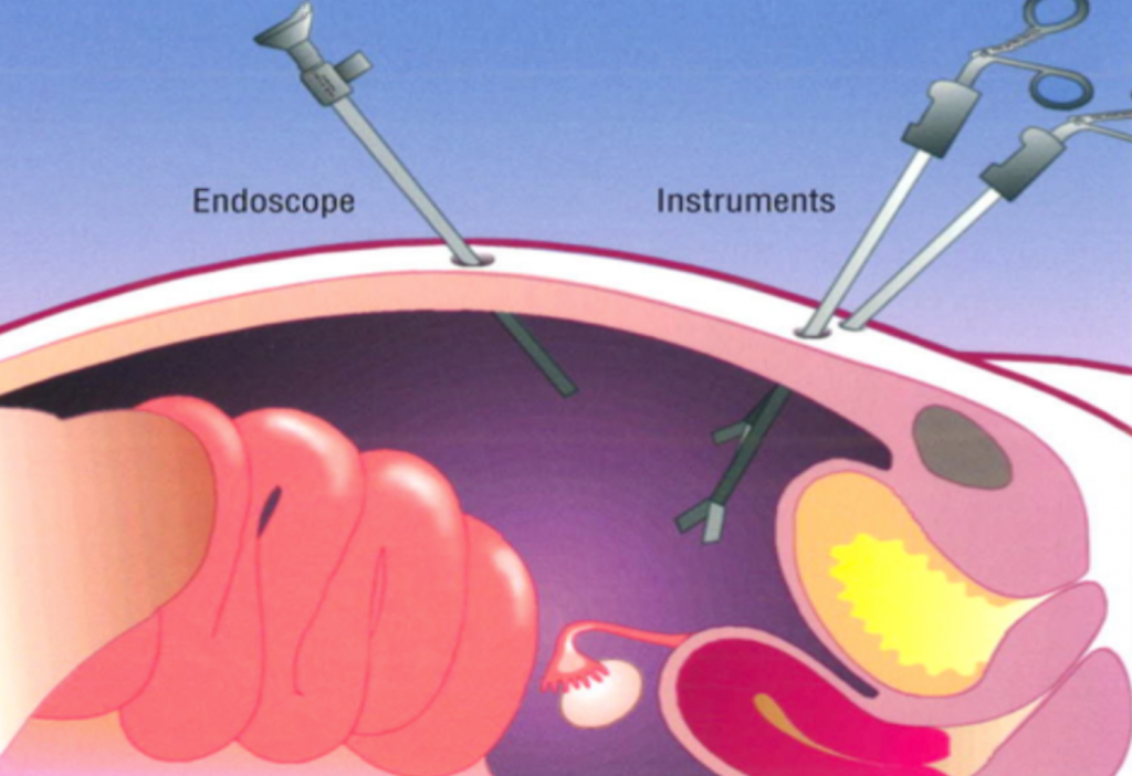 Fibroids - Anthony Siow