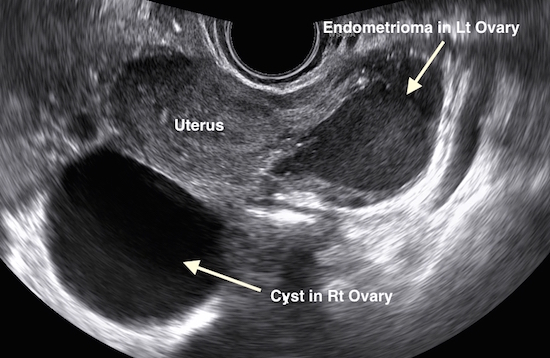 Ovarian Cysts - Anthony Siow