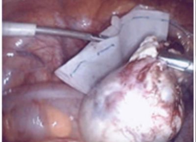 ovarian cyst cancer cysts surgery laparoscopic keyhole laparoscopy