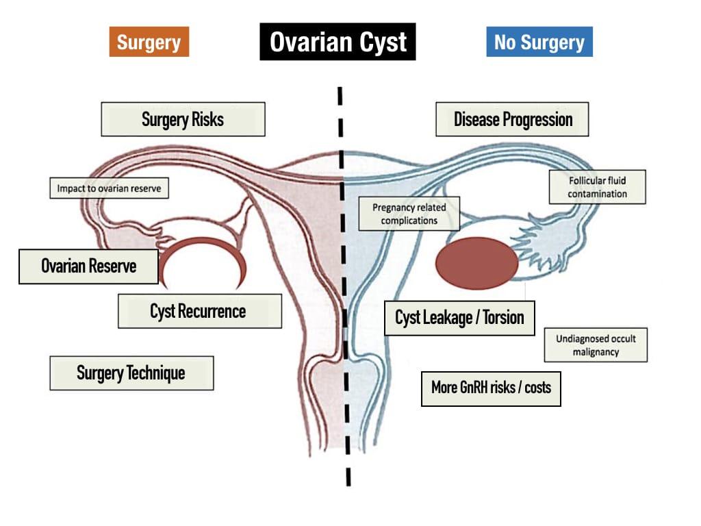 Ovarian Cysts - Anthony Siow