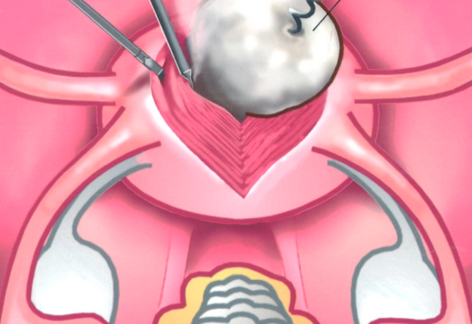 Laproscopy Incision Infected Single Incision Laparoscopy - Landmark Cases - Anthony Siow