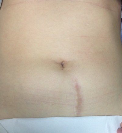 Single Incision Laparoscopy - Anthony Siow