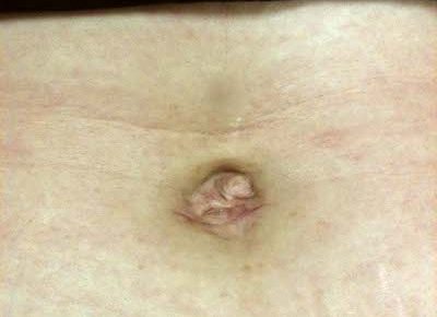 belly button incision bleeding