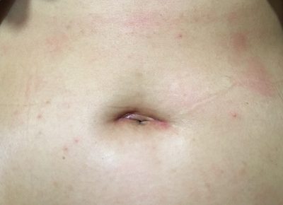 belly button incision care