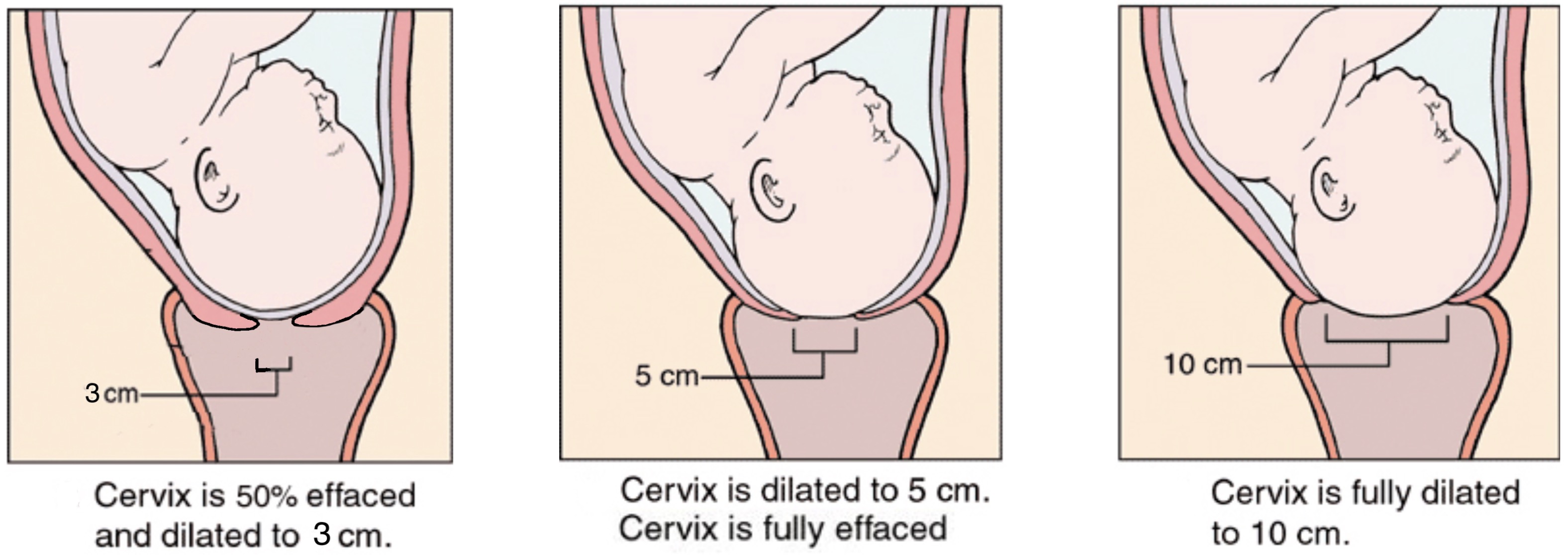 How Long 3cm Dilated