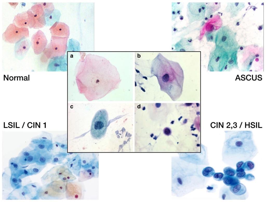 Atypical Squamous Cells Of Undetermined Significance Asc Us Pregnancy