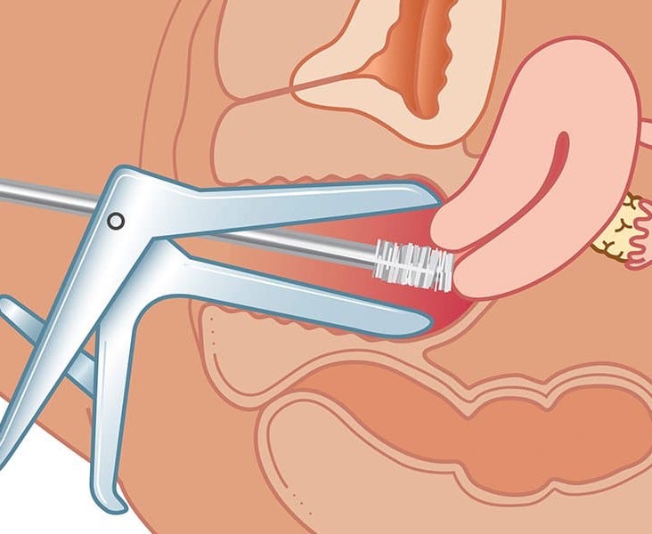 Ascus Pap Smear Hpv Anthony Siow