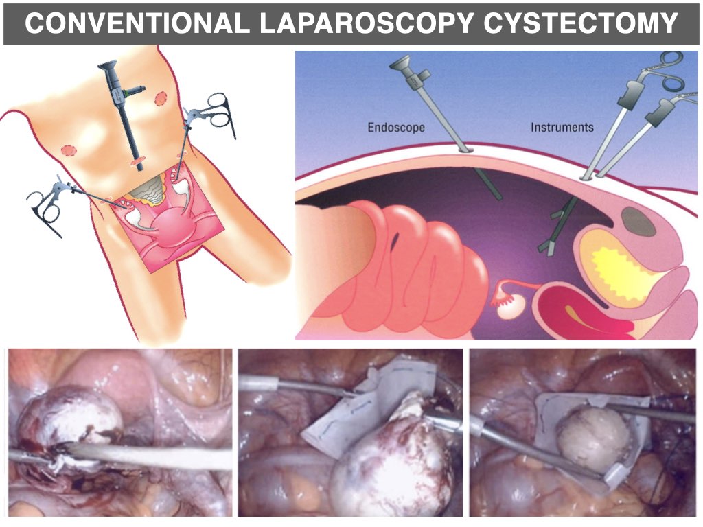 Ovarian Cysts Removal using Laparoscopy