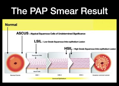 ASCUS PAP Smear & HPV - Anthony Siow