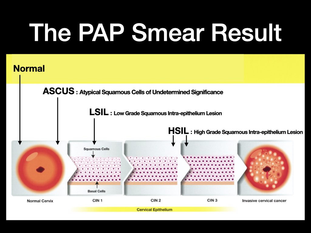 ASCUS PAP Smear HPV Anthony Siow