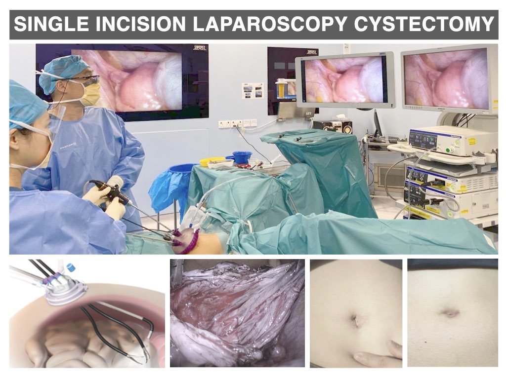 Laparoscopic resection of a torted ovarian dermoid cyst