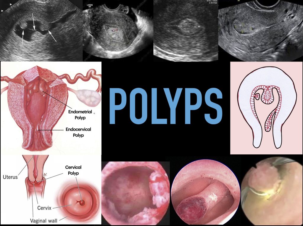 Cervical Polyp: Causes, Symptoms, Diagnosis & Treatment