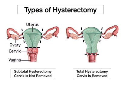 Hysterectomy - Anthony Siow