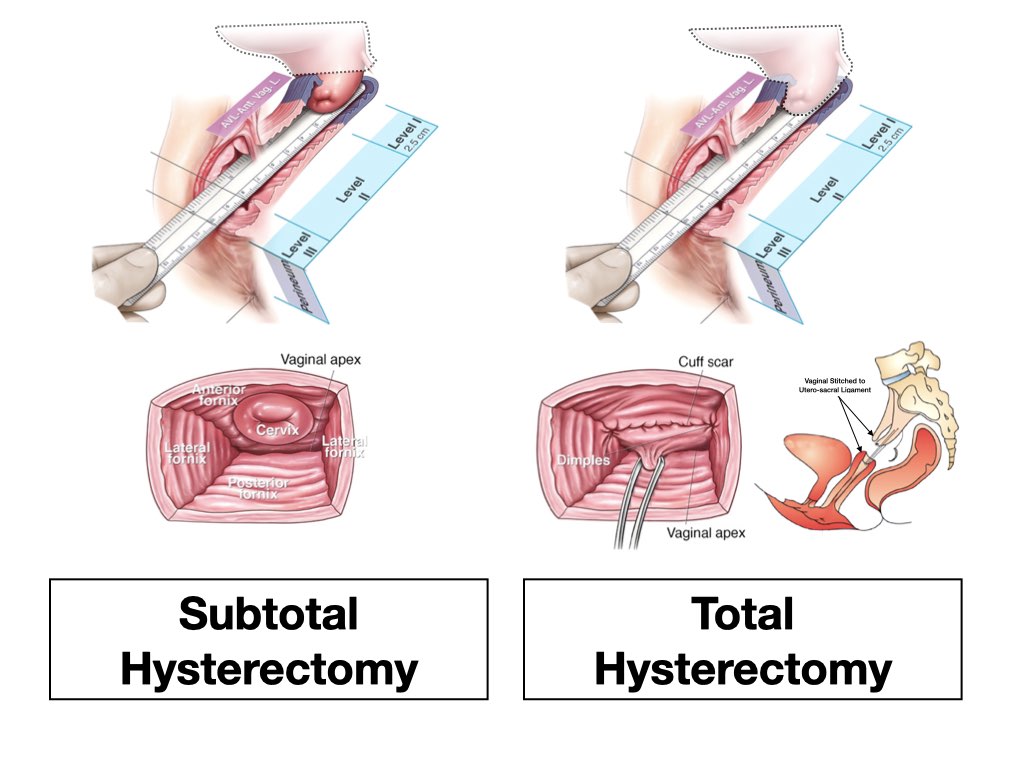Hysterectomy - Anthony Siow