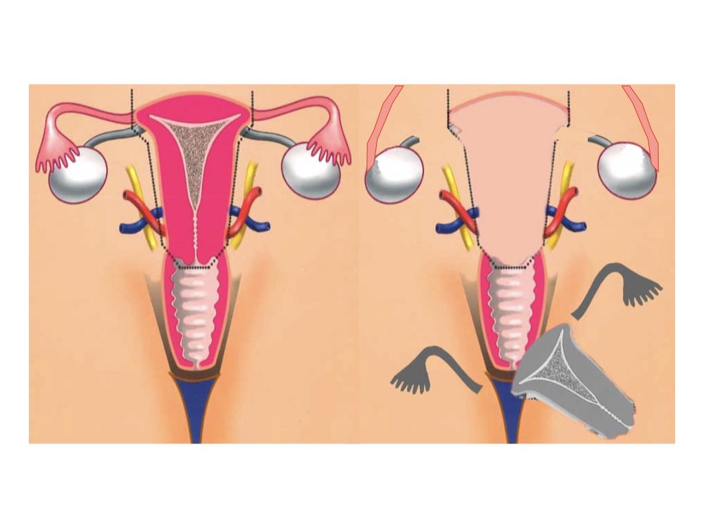 Vaginal Discharge After Hysterectomy