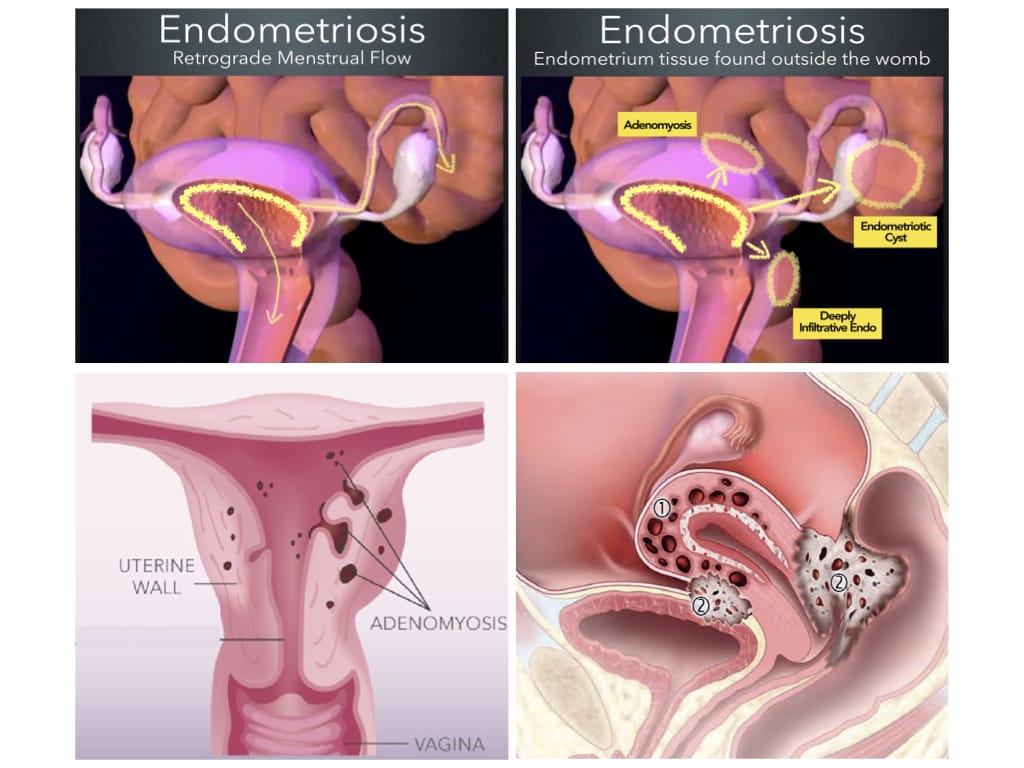 Drug Free Endometriosis, Period & Pelvic Pain Relief