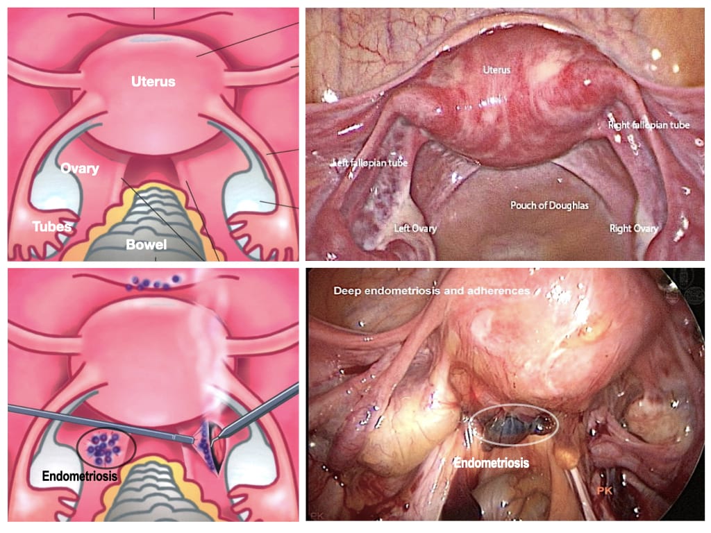 Man v Endometriosis #periodpainsimulator #endo #endometriosis