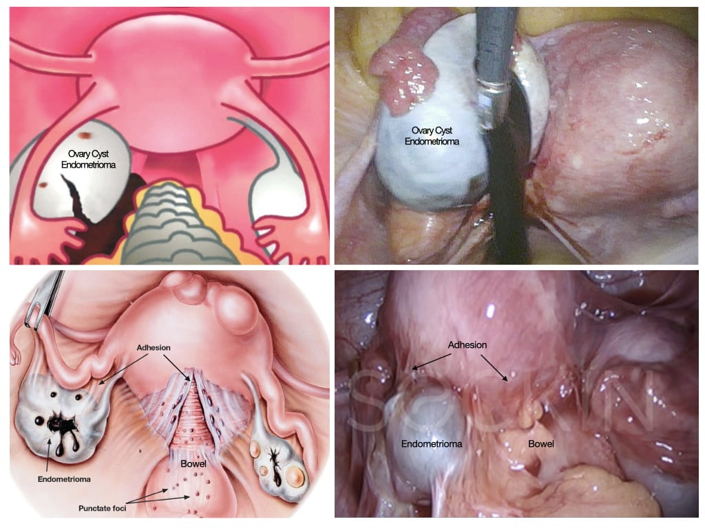 Painful Periods - Endometriosis - Adenomyosis - Anthony Siow