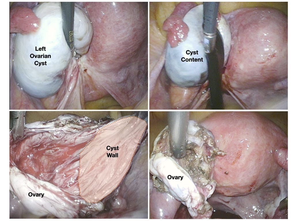 Painful Periods - Endometriosis - Adenomyosis - Anthony Siow